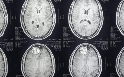 Tumor Cerebral Masculino 43 Años