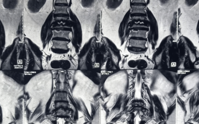 Osteoporosis, Masculino de 66 años