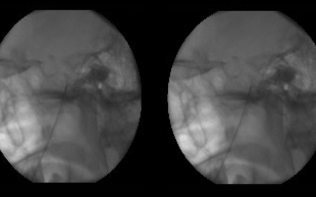 Rizotomía Pércutanea con Radiofrecuencia del Nervio Trigémino