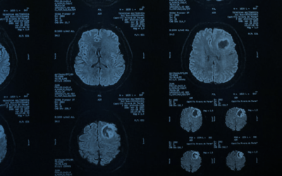 Afasia de Broca Tumor Frontal Izquierdo