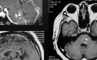 Malformación Arteriovenosa Pontina Cerebral