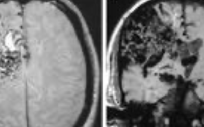 Ejemplos de malformación arteriovenosa cerebral